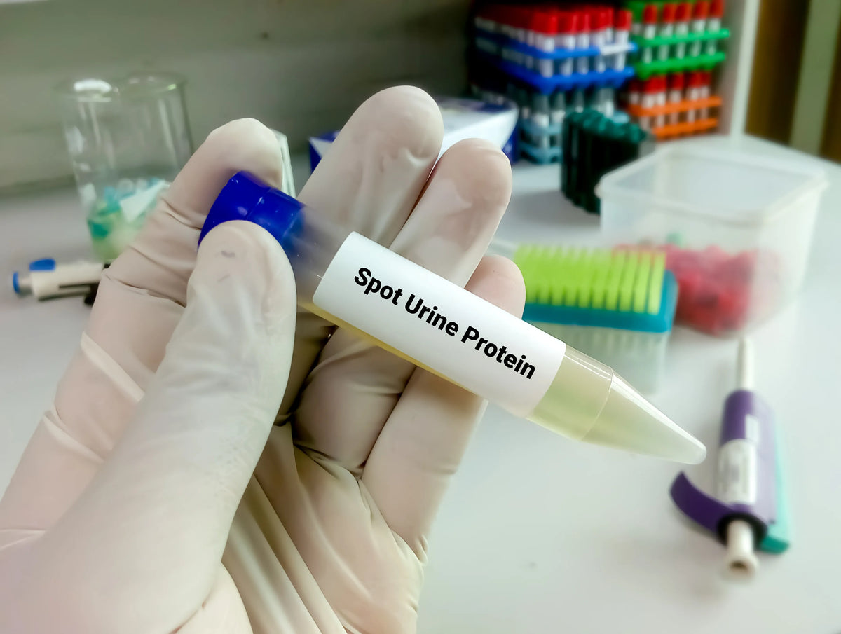 Protein in Urine: Causes and Symptoms
