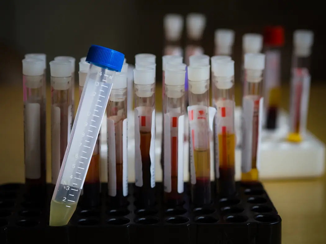 Correlation of Uric Acid Levels in Saliva, Blood, and Urine